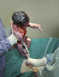 Caesarean Section C-section Labour Birth